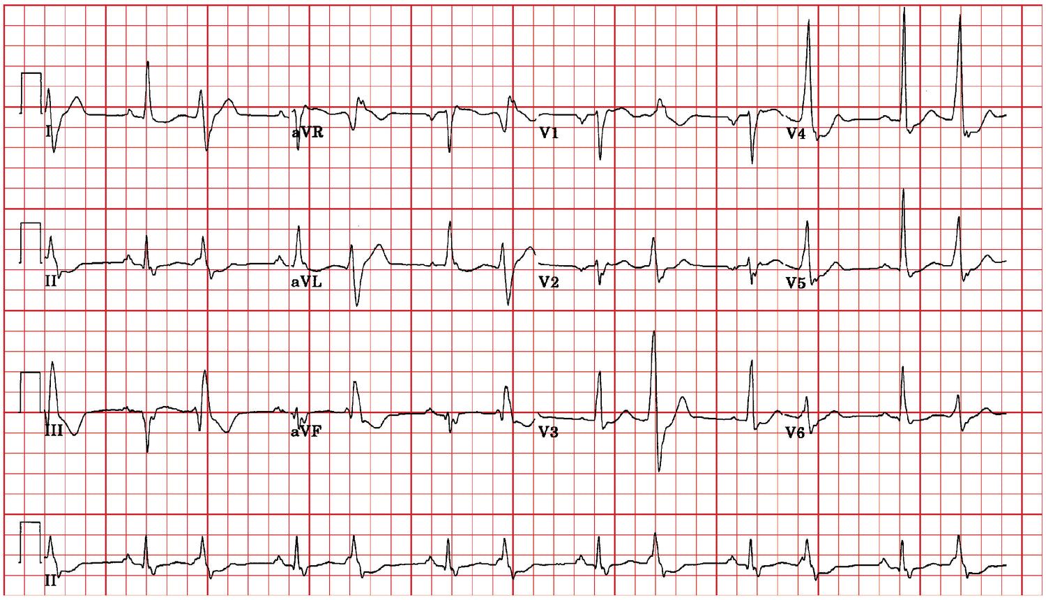 ECG