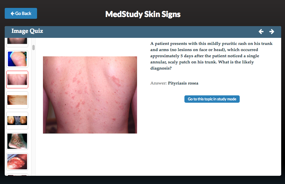 Image quiz with Pityriasis rosea as the answer