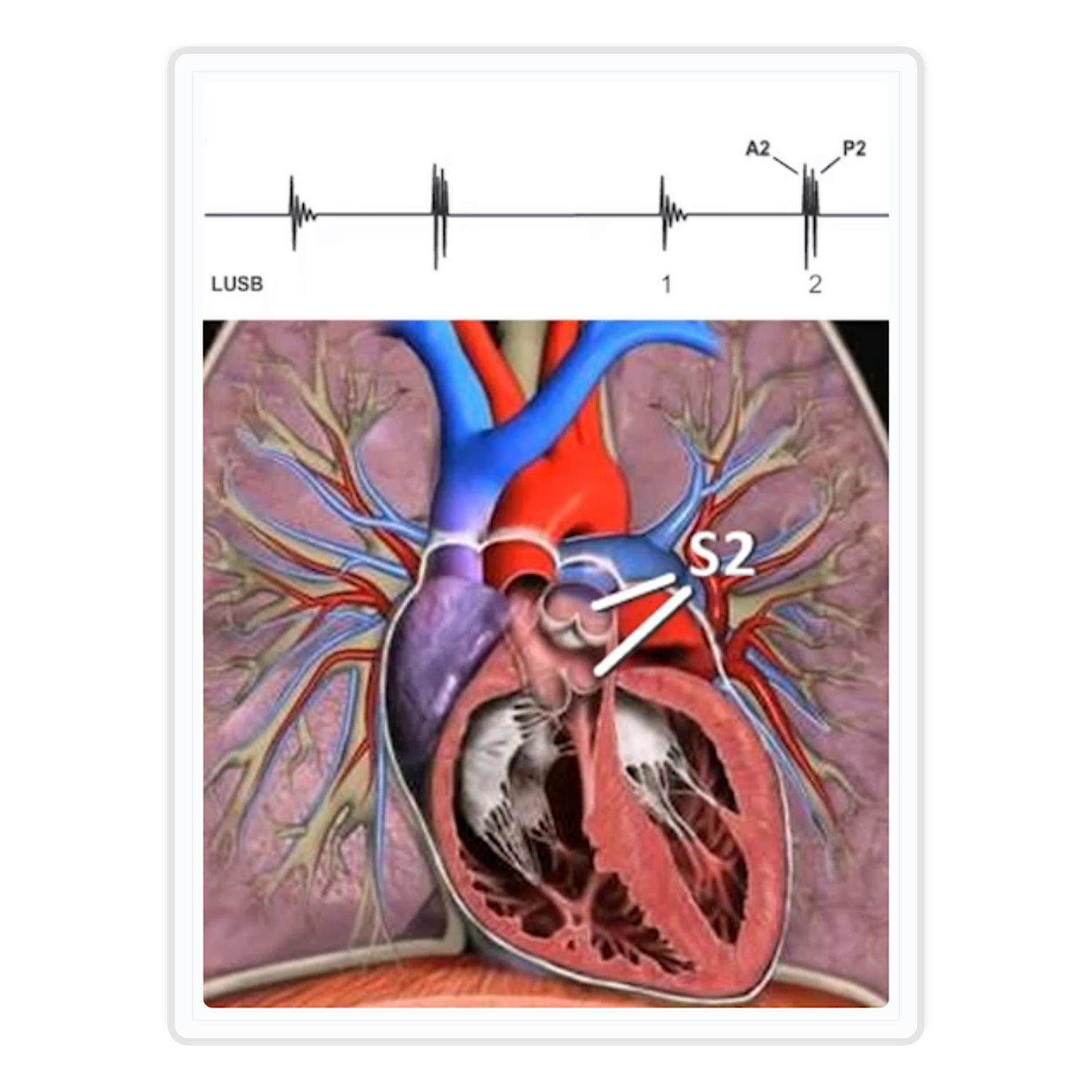S2 placement on heart anatomy and LUSB