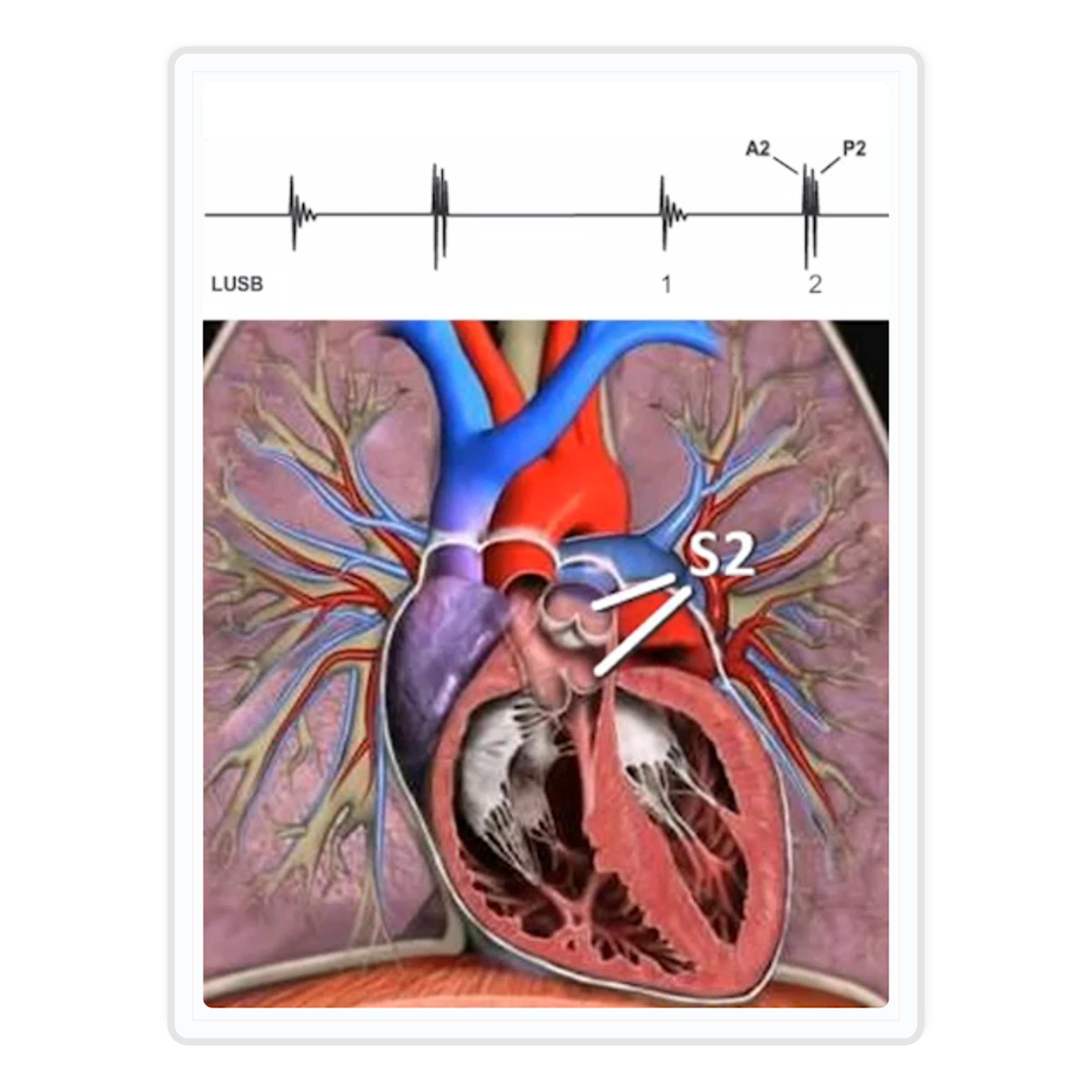 S2 placement on heart anatomy and LUSB